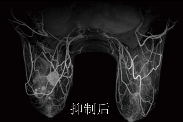 優異的脂肪抑制技術