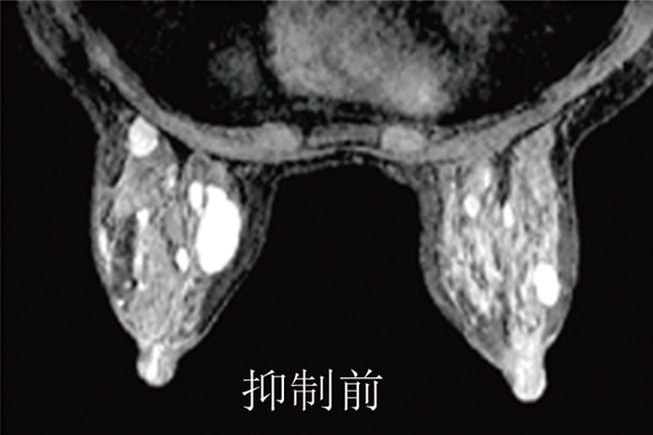優異的脂肪抑制技術